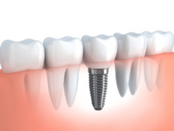 Dental implant services in Craven County, North Carolina