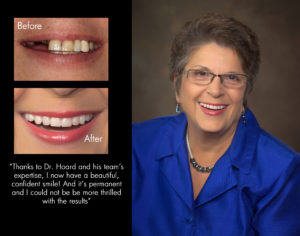 Barbara, New Bern North Carolina cosmetic dentist patient photos