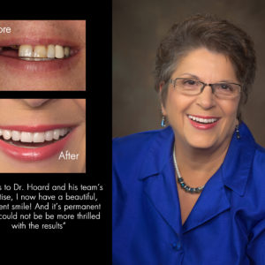 Barbara, New Bern North Carolina cosmetic dentist patient photos