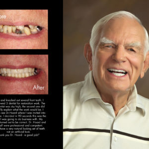 Bert, New Bern North Carolina cosmetic dentist patient photos