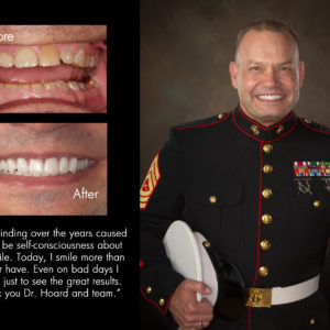 Chris, New Bern North Carolina cosmetic dentist patient photos