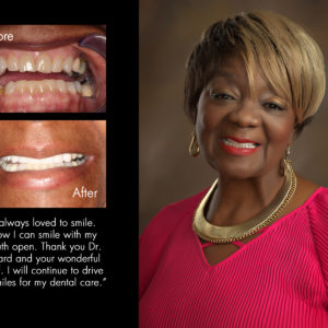 Johnnie, New Bern North Carolina cosmetic dentist patient photos