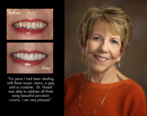 Linda, New Bern North Carolina cosmetic dentist patient photos