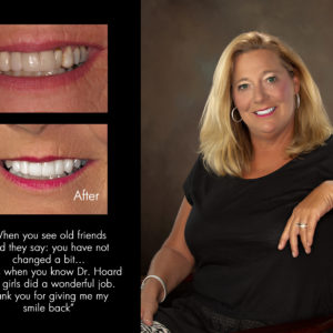 Marlene, New Bern North Carolina cosmetic dentist patient photos