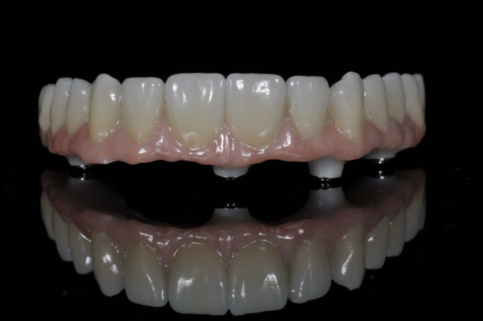 affordable all-on-four implants in New Bern North Carolina