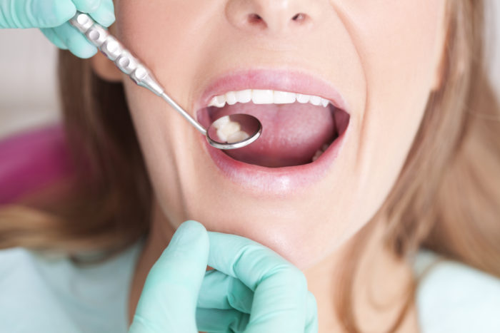 Dental Filling Treatment in New Bern, North Carolina