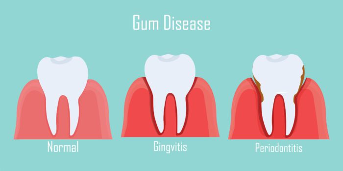 periodontal treatment in new bern nc