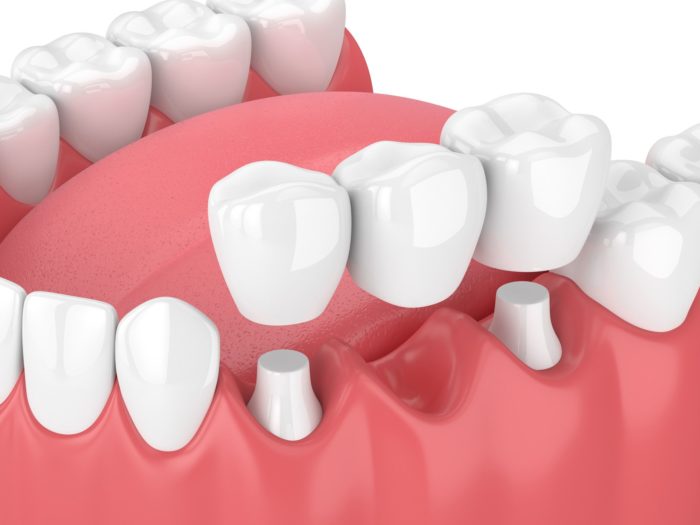 3d render of jaw with dental bridge over white background dental bridges dentist in New Bern North Carolina
