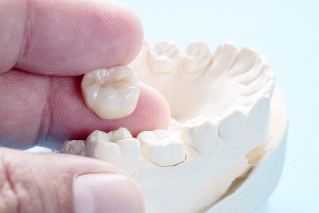 5 Benefits of Dental Crowns