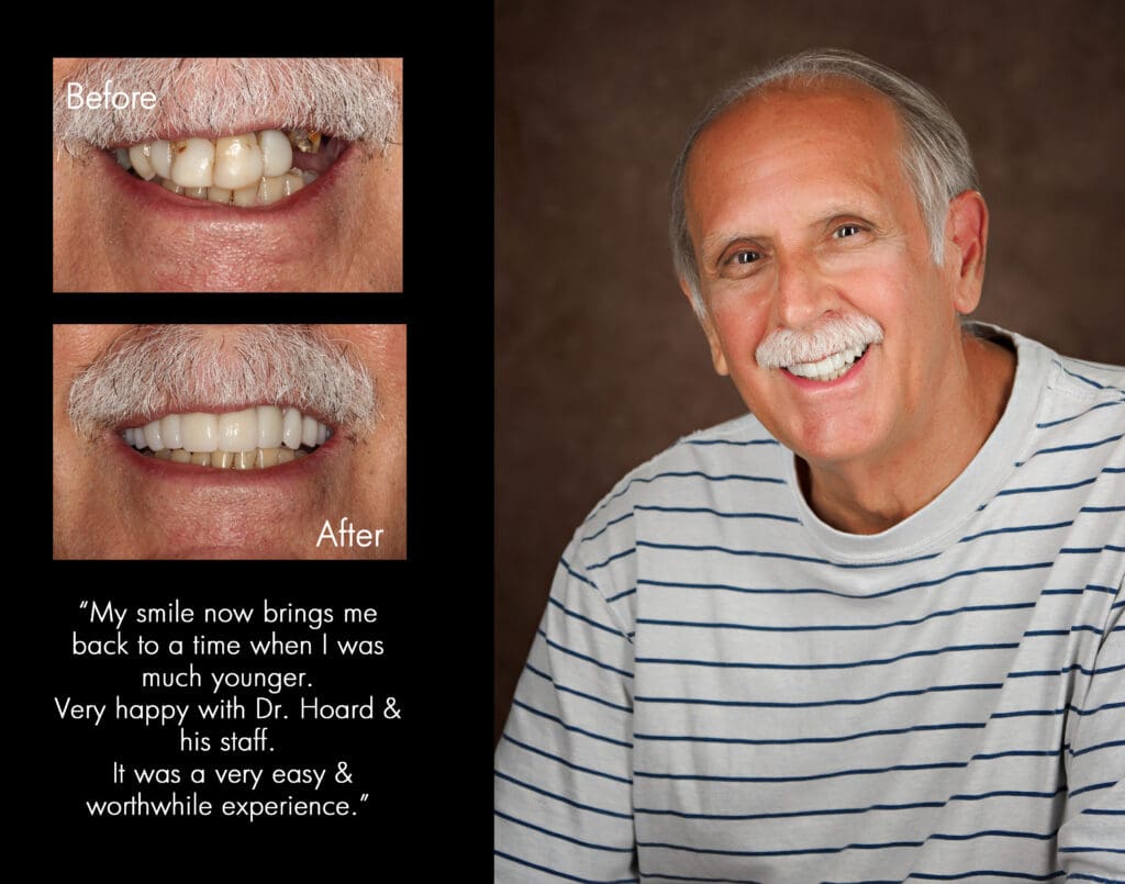 Patient before and after dental implants at Hoard & Hoard Cosmetic and Restorative Dentistry