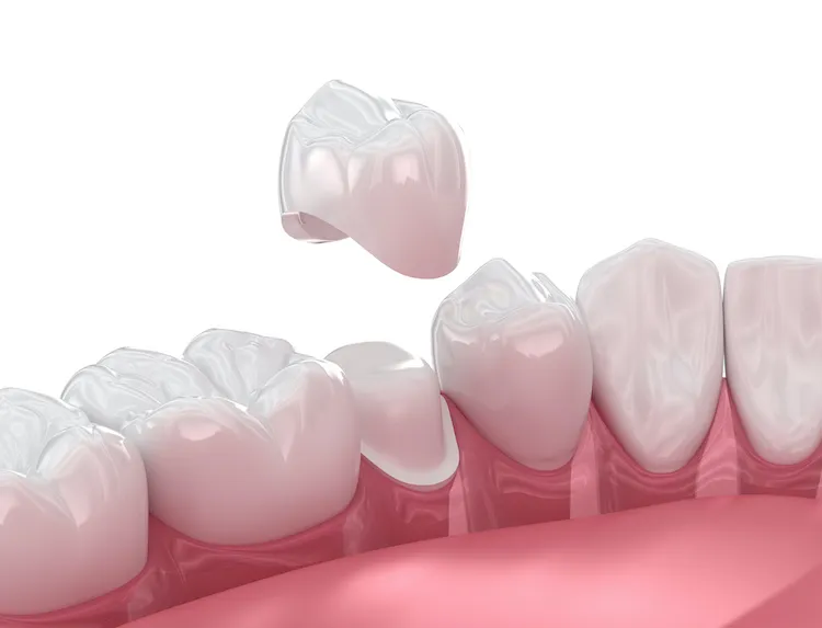 What Exactly Is a Dental Crown? in New Bern, NC